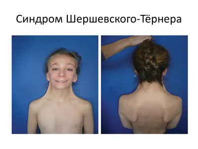 Синдром шерешевского тернера картинки фотографии