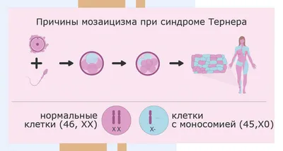 Синдром Шерешевского-Тернера