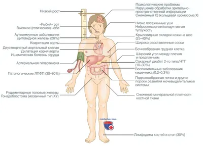 Мозаичный вариант синдрома Тернера uMEDp