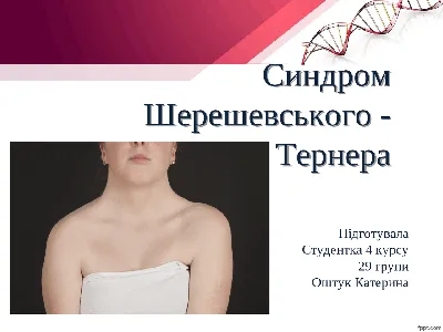 Общество \"Жизнь с синдромом Тернера – Шерешевского\" – Общество Жизнь с синдромом  Шерешевского Тернера, а также взаимопомощь людей живущих с диагнозом , Live  with Turner Sindrom