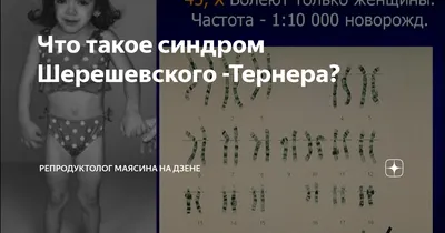 Синдром Шерешевского – Тернера – этиология, симптомы