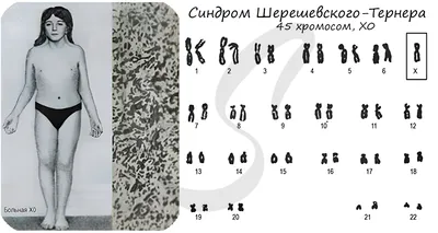 Синдром Нунан — Википедия