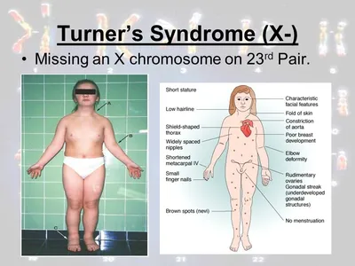 Синдром Тернера | Жизнь для нас и про нас | Дзен