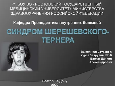 Синдром Шерешевского - Тернера: фенотипическая вариабельность хромосомного  полиморфизма – тема научной статьи по клинической медицине читайте  бесплатно текст научно-исследовательской работы в электронной библиотеке  КиберЛенинка