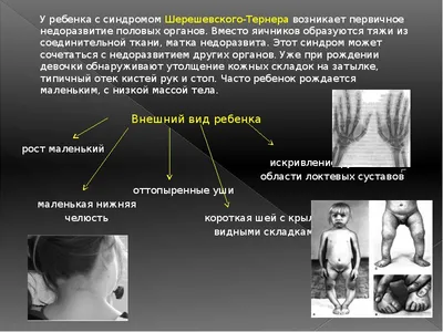 Синдром дисгенезии гонад (тип Шерешевского-Тернера) у ребёнка раннего  возраста – тема научной статьи по клинической медицине читайте бесплатно  текст научно-исследовательской работы в электронной библиотеке КиберЛенинка