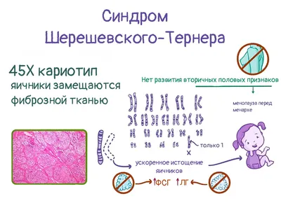 Трудности диагностики синдрома Шерешевского Тернера в практике акушера  гинеколога. Генетический полиморфизм как причина поздней диагностики  синдрома – тема научной статьи по клинической медицине читайте бесплатно  текст научно-исследовательской работы в ...