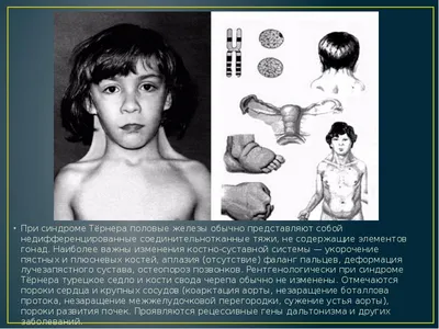 Презентация по Генетике человека с основами медицинской генетики на тему \"Синдром  Шерешевского-Тернера\"