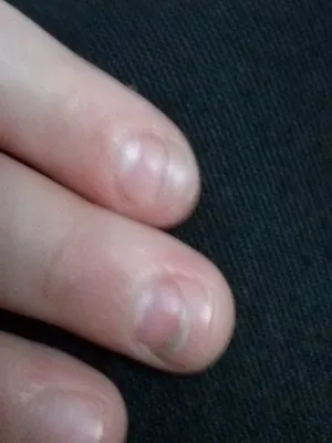 Изображение рук с проблемой слоящихся ногтей в высоком разрешении