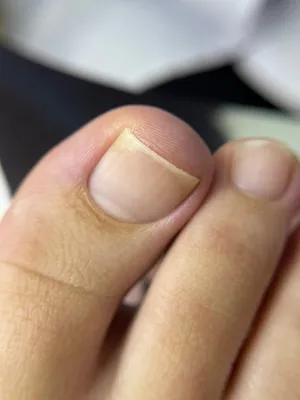 WebP фото слоящихся ногтей на руках: как избежать проблемы