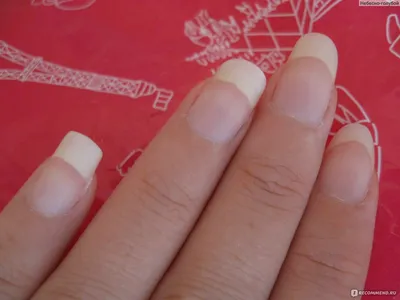 Скачать фото слоящихся ногтей на руках в формате PNG