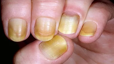 PNG изображение рук с проблемой слоящихся ногтей: лечение