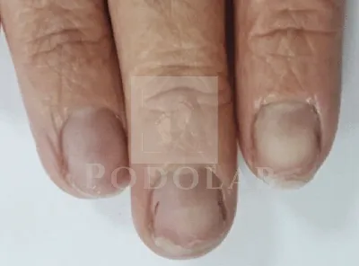 WebP фотография, демонстрирующая слоящиеся ногти на руках