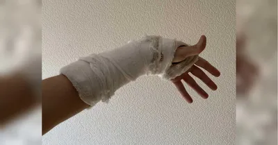 Фото руки с переломом во время лечения