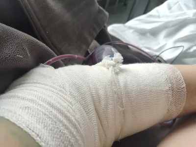 Фотография сломанной руки без гипса для медицинских целей
