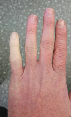 Сломанный палец на руке: фото в формате JPG