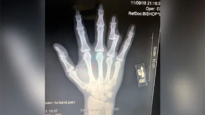 Фотография сломанного пальца на руке с использованием дрона