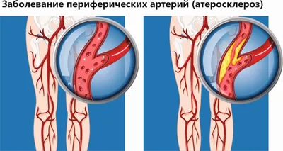 Сосудистые заболевания ног в картинках фото