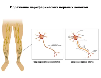 Полинейропатия - причины появления, при каких заболеваниях возникает,  диагностика и способы лечения