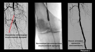 Облитерирующий атеросклероз сосудов и артерий нижних конечностей – лечение,  операция в СПб, цена