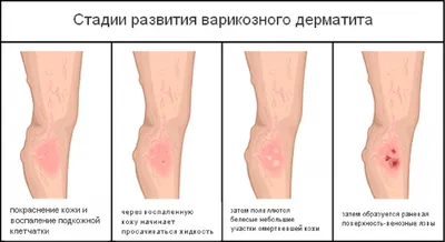 Трещины на стопах - причины, симптомы, диагностика, лечение и профилактика