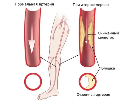 Облитерирующий атеросклероз сосудов и артерий нижних конечностей – лечение,  операция в СПб, цена