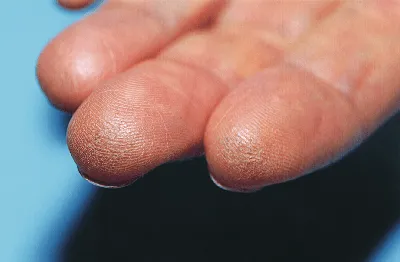 Стержневая мозоль на пальце руки: фотография для блога