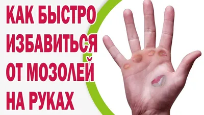 Стержневая мозоль на пальце руки: изображение для научных публикаций