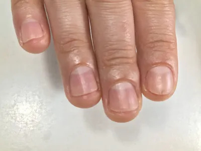 Стержневая мозоль на пальце руки: изображение для медицинских журналов