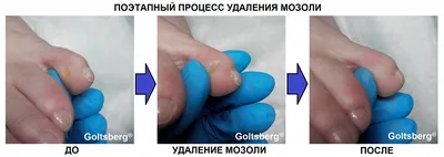 Стержневая мозоль на пальце руки: как не допустить осложнений