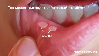 Стоматит У Детей 9 Фото Лечение Как Вылечить ЛюмиДент