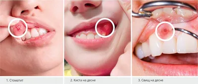 Афтозный стоматит: симптомы, причины и лечение - Альянс бьюти-стоматологов,  Москва