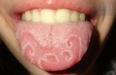 Афтозный стоматит: симптомы, диагностика хронического язвенного стоматита и  лечение слизистой оболочки у стоматолога