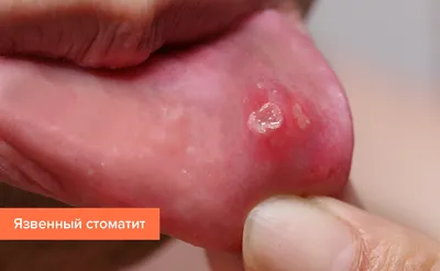 Стоматит: диагностика и качественное лечение в Харькове