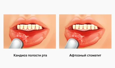 Афтозный стоматит: симптомы, диагностика хронического язвенного стоматита и  лечение слизистой оболочки у стоматолога