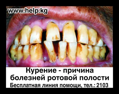 Армянских курильщиков попытаются отучить от вредной привычки \"страшными  картинками\" (фото) - Times.am