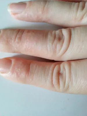 Стрептодермия на пальцах рук фото