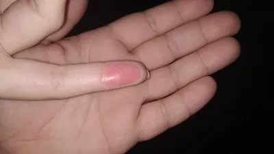 Изображение стрептодермии на пальцах рук в формате PNG