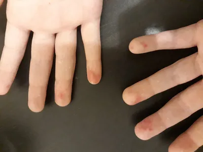 Картинка стрептодермии на пальцах рук: Снимок с макрообъективом