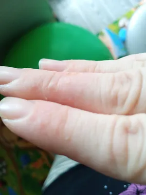 Фото стрептодермии на пальцах рук: Низкое разрешение для быстрой загрузки