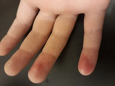 Картинка стрептодермии на пальцах рук: Настраиваемый размер для вашего удобства