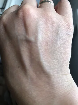 Изображение стрептодермии на пальцах рук: Снимок с использованием технологии HDR