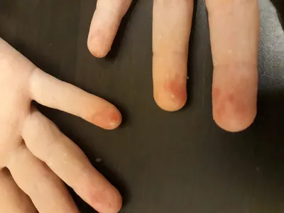 Картинка стрептодермии на пальцах рук: Крупный план