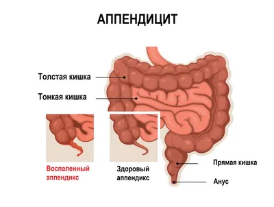 Почему возникает паховая грыжа: опасна ли она и всегда ли нужна операция? |  О здоровье: с медицинского на русский | Дзен