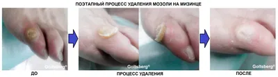 Сухая мозоль на пальце руки с эффектом моушн-блюр