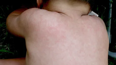 Сыпь на коже рук малыша: фото для диагностики