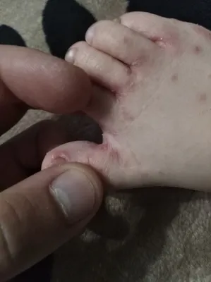 Фото сыпи на руках и ногах маленького ребенка для медицинских целей