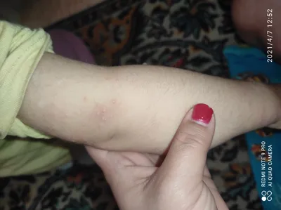 Сыпь на коже рук малыша: изображение в высоком разрешении