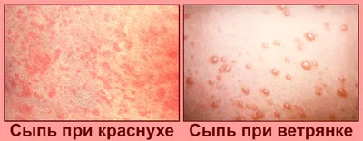 Изображение сыпи на руках и ногах: скачать в разных форматах