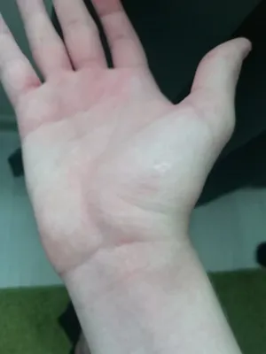Изображение солнечной сыпи на руках для любителей загара