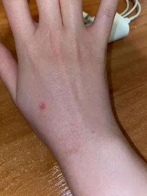 Фото с сыпью на руках: как выглядит солнечная аллергия